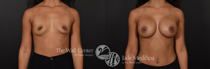 Before & After Breast Augmentation Case 599 View #1 View in Shreveport, LA