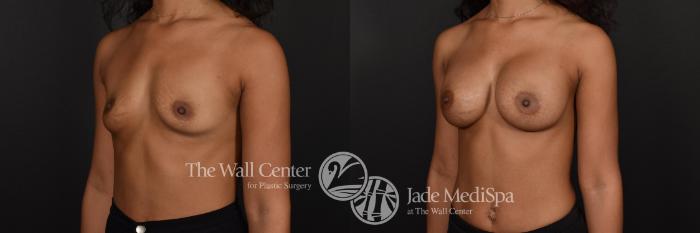Before & After Breast Augmentation Case 599 View #2 View in Shreveport, LA