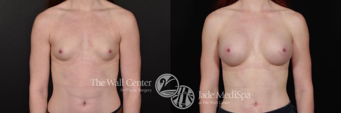 Before & After Breast Augmentation Case 602 View #1 View in Shreveport, LA