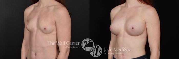 Before & After Breast Augmentation Case 602 View #2 View in Shreveport, LA