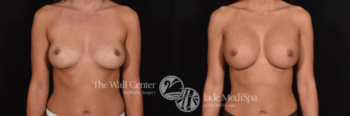Before & After Breast Augmentation Case 606 View #1 View in Shreveport, LA