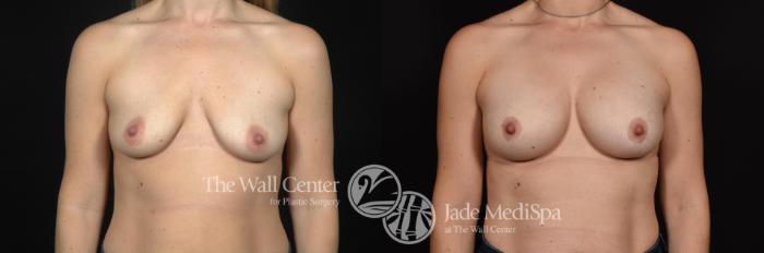Before & After Breast Augmentation with Lift Case 629 View #1 View in Shreveport, LA