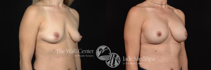 Before & After Breast Augmentation with Lift Case 629 View #2 View in Shreveport, LA