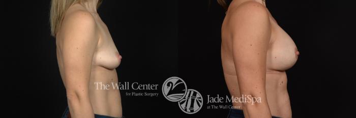 Before & After Breast Augmentation with Lift Case 629 View #3 View in Shreveport, LA