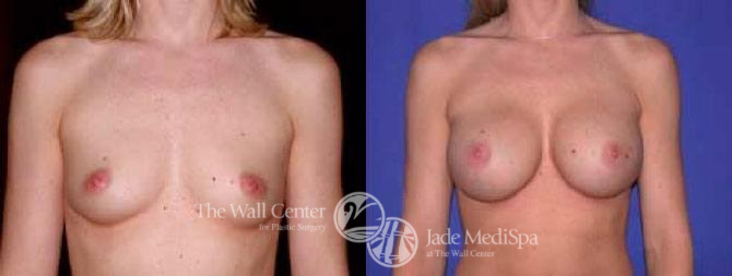 Before & After Breast Augmentation Case 63 View #1 View in Shreveport, LA