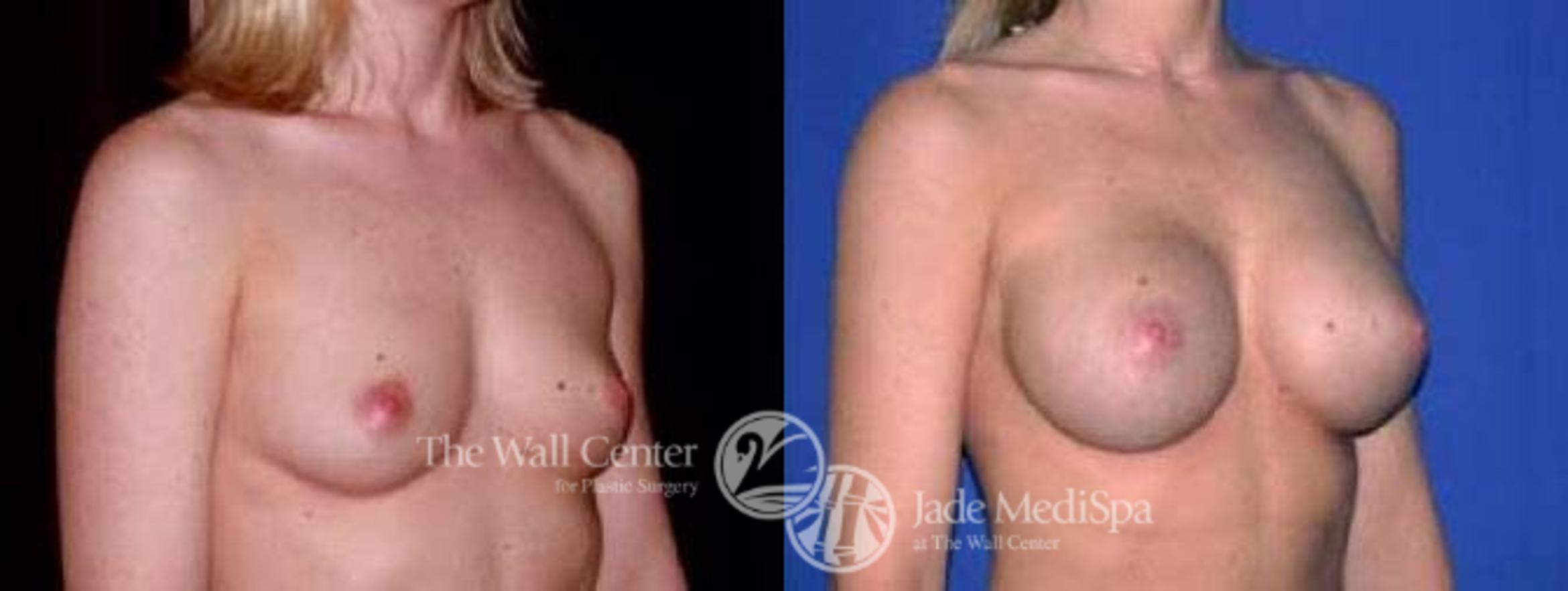 Before & After Breast Augmentation Case 63 View #2 View in Shreveport, LA