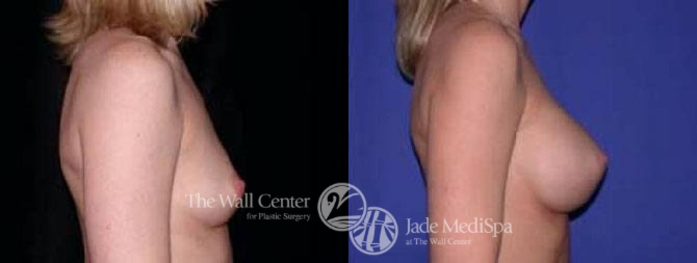 Before & After Breast Augmentation Case 63 View #3 View in Shreveport, LA