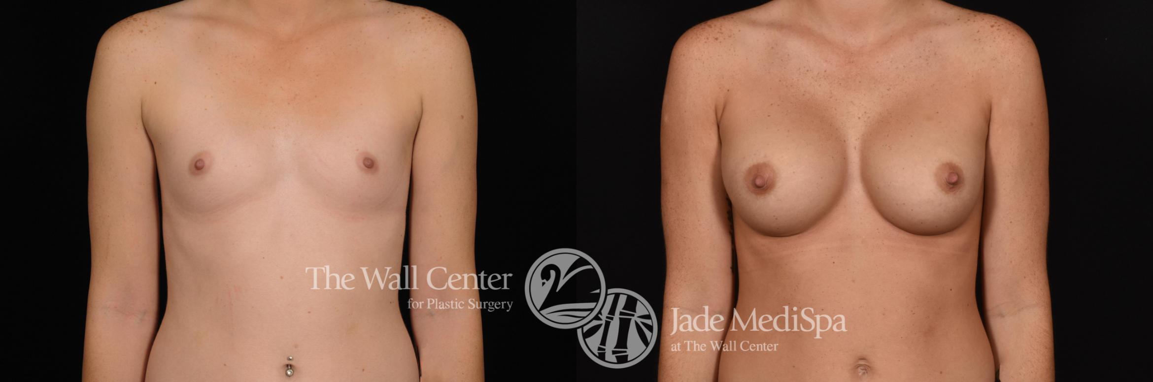 Before & After Breast Augmentation Case 643 VIEW #1 View in Shreveport, LA