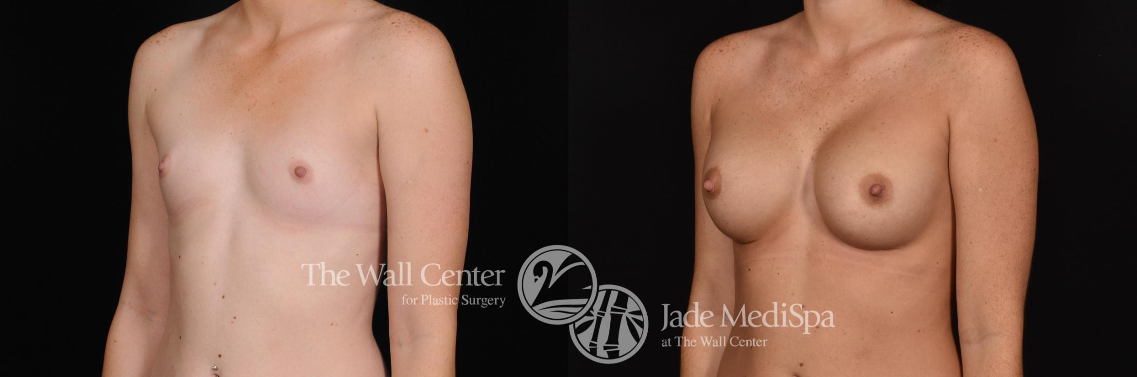 Before & After Breast Augmentation Case 643 VIEW #2 View in Shreveport, LA