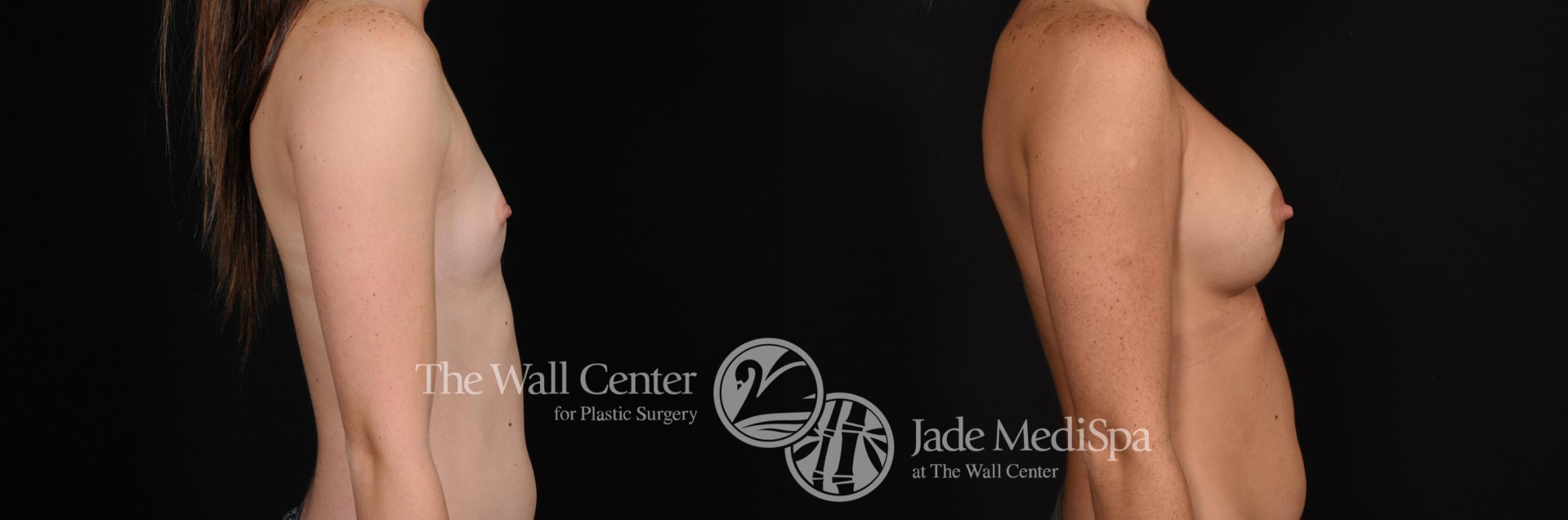 Before & After Breast Augmentation Case 643 VIEW #3 View in Shreveport, LA