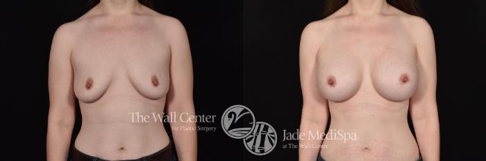 Before & After Breast Augmentation Case 674 VIEW #1 View in Shreveport, LA