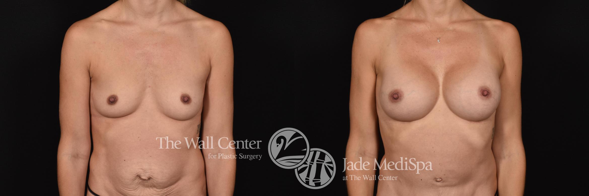 Before & After Breast Augmentation Case 682 VIEW #1 View in Shreveport, LA