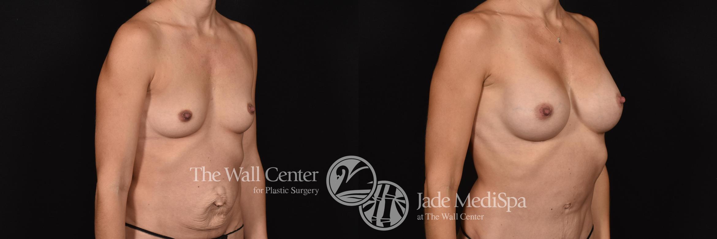 Before & After Breast Augmentation Case 682 VIEW #2 View in Shreveport, LA