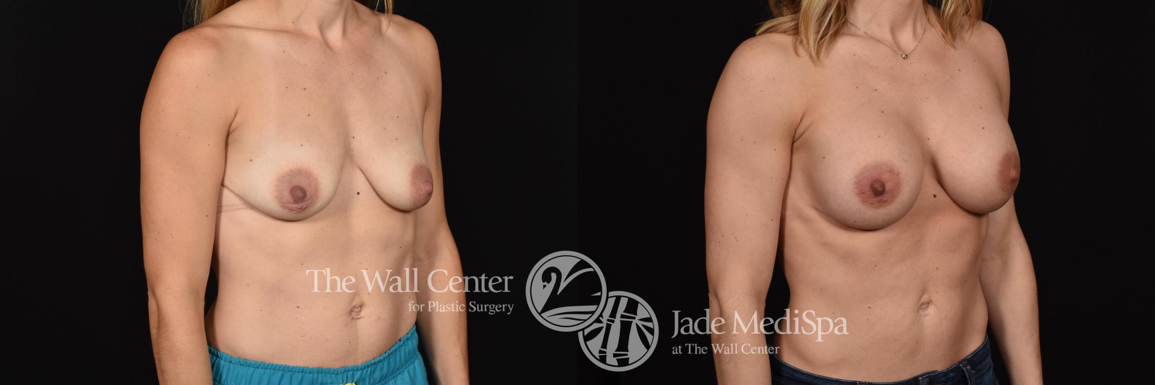 Before & After Breast Augmentation Case 696 VIEW #2 View in Shreveport, LA