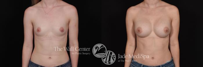 Before & After Breast Augmentation Case 697 VIEW #1 View in Shreveport, LA