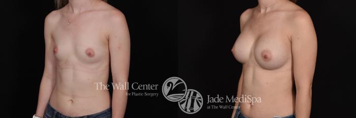 Before & After Breast Augmentation Case 697 VIEW #2 View in Shreveport, LA
