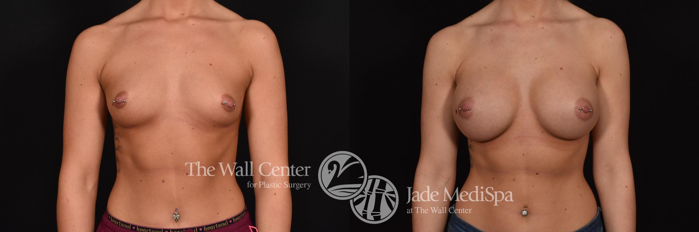 Before & After Breast Augmentation Case 703 VIEW #1 View in Shreveport, LA