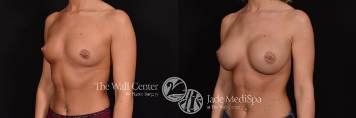 Before & After Breast Augmentation Case 703 VIEW #2 View in Shreveport, LA