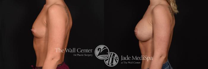Before & After Breast Augmentation Case 703 VIEW #3 View in Shreveport, LA