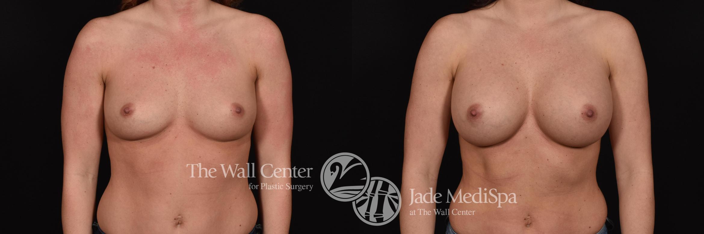 Before & After Breast Augmentation Case 704 VIEW #1 View in Shreveport, LA