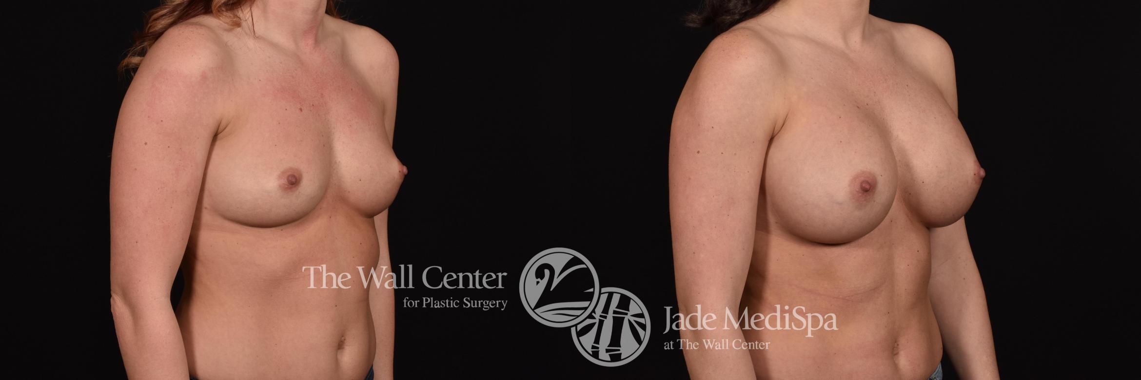 Before & After Breast Augmentation Case 704 VIEW #2 View in Shreveport, LA