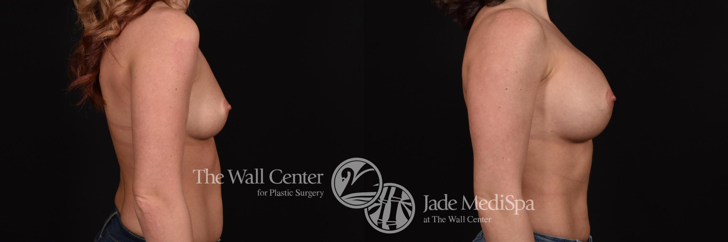 Before & After Breast Augmentation Case 704 VIEW #3 View in Shreveport, LA