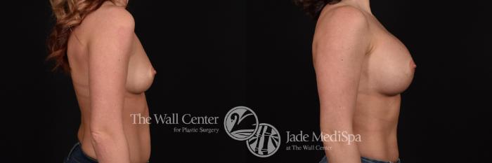 Before & After Breast Augmentation Case 704 VIEW #3 View in Shreveport, LA