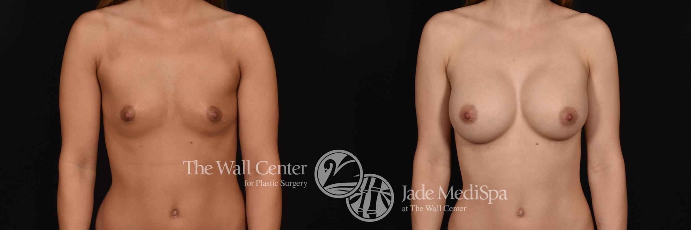 Before & After Breast Augmentation Case 705 VIEW #1 View in Shreveport, LA