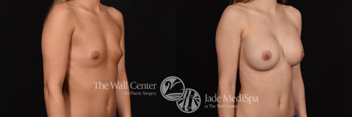 Before & After Breast Augmentation Case 705 VIEW #2 View in Shreveport, LA