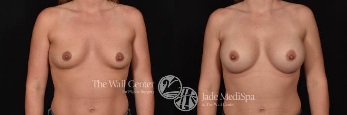 Before & After Breast Augmentation Case 707 VIEW #1 View in Shreveport, LA