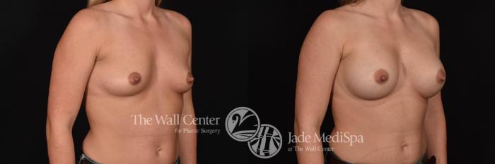 Before & After Breast Augmentation Case 707 VIEW #2 View in Shreveport, LA