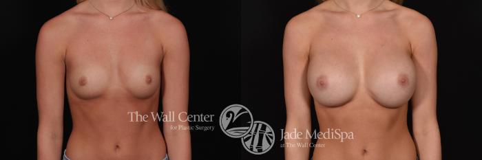 Before & After Breast Augmentation Case 714 VIEW #1 View in Shreveport, LA