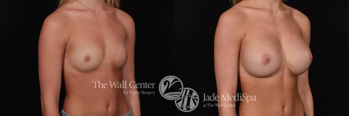 Before & After Breast Augmentation Case 714 VIEW #2 View in Shreveport, LA