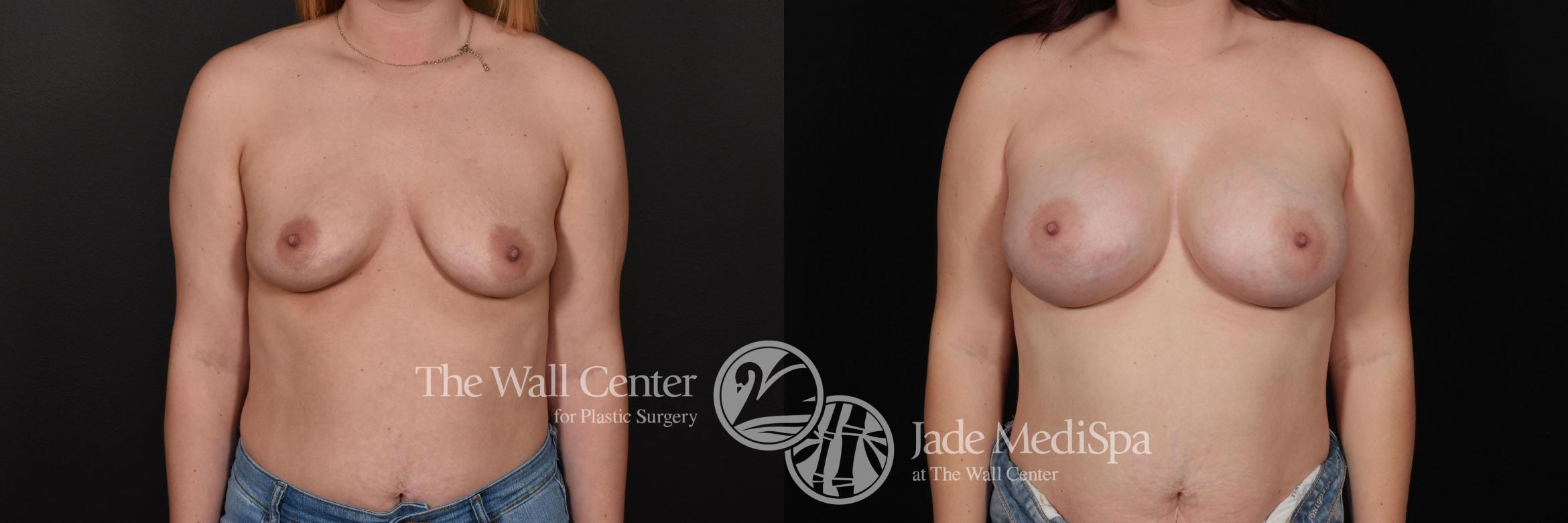 Before & After Breast Augmentation Case 717 VIEW #1 View in Shreveport, LA
