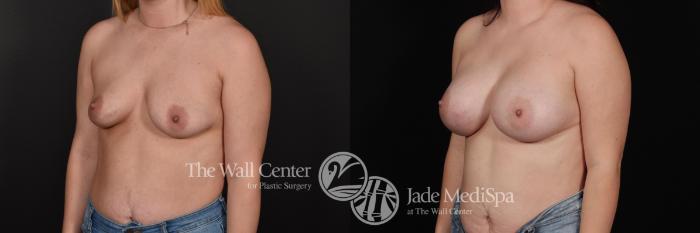 Before & After Breast Augmentation Case 717 VIEW #2 View in Shreveport, LA
