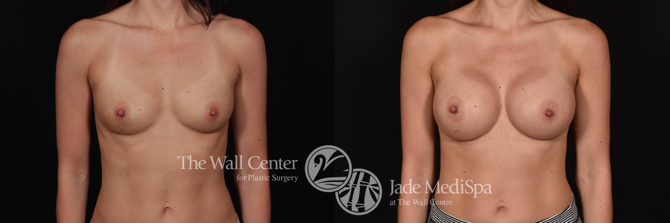 Before & After Breast Augmentation Case 729 VIEW #1 View in Shreveport, LA