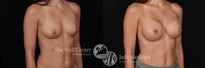 Before & After Breast Augmentation Case 729 VIEW #2 View in Shreveport, LA