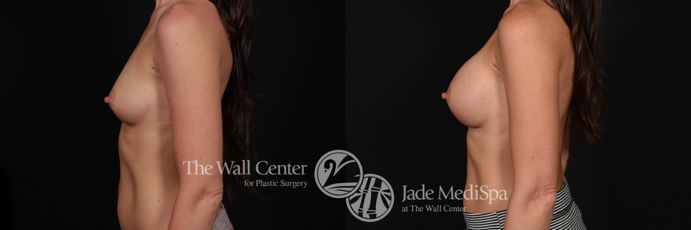 Before & After Breast Augmentation Case 729 VIEW #3 View in Shreveport, LA