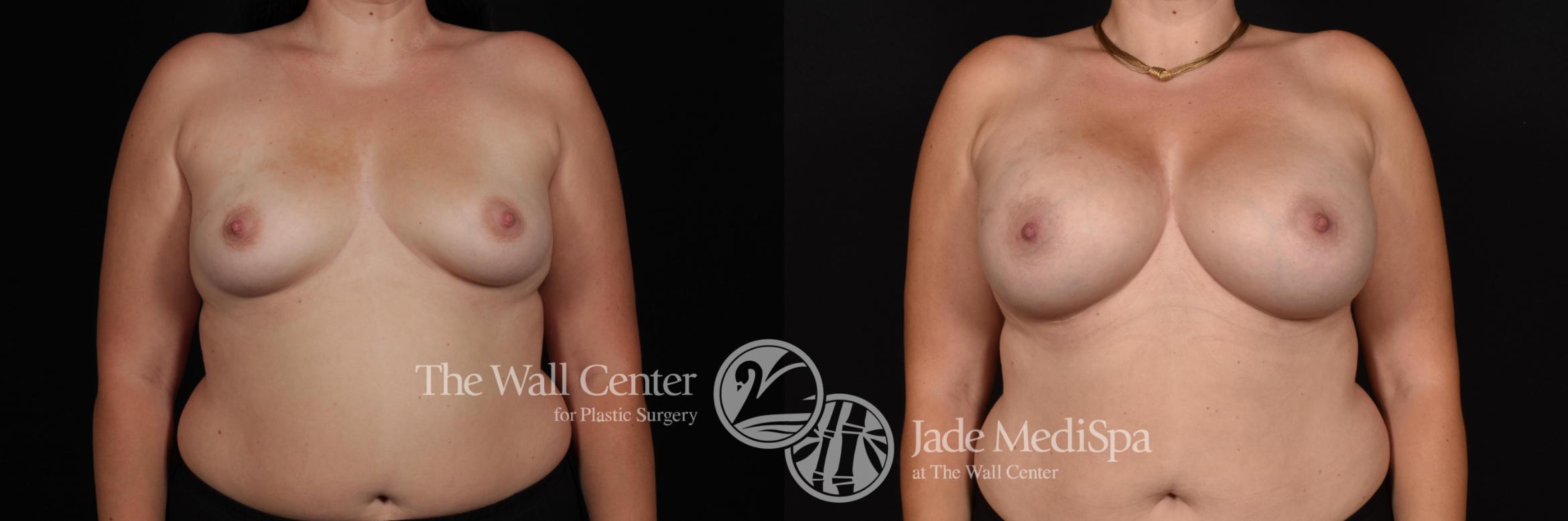 Before & After Breast Augmentation Case 732 VIEW #1 View in Shreveport, LA