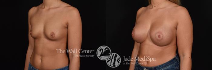 Before & After Breast Augmentation Case 733 VIEW #2 View in Shreveport, LA