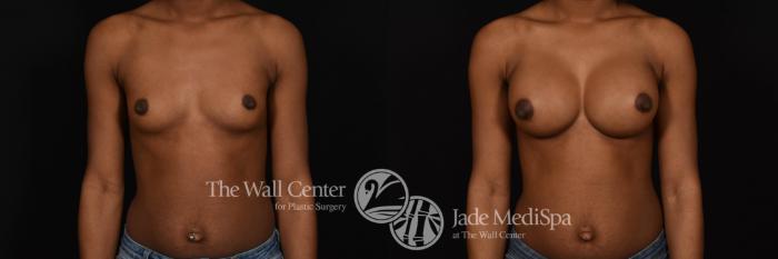 Before & After Breast Augmentation Case 738 VIEW #1 View in Shreveport, LA