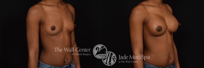 Before & After Breast Augmentation Case 738 VIEW #2 View in Shreveport, LA