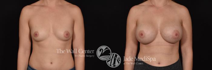 Before & After Breast Augmentation Case 739 VIEW #1 View in Shreveport, LA