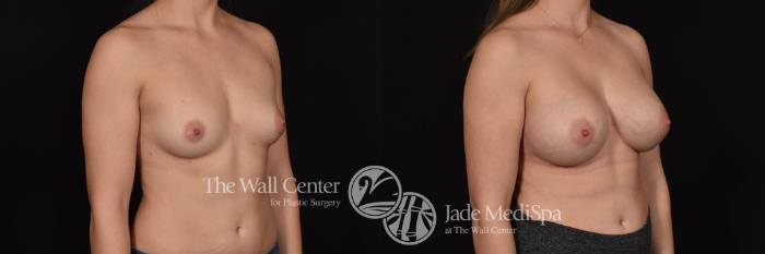 Before & After Breast Augmentation Case 739 VIEW #2 View in Shreveport, LA