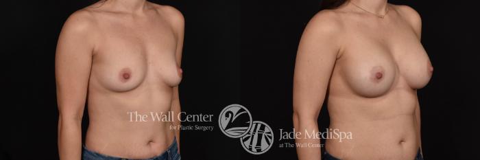 Before & After Breast Augmentation Case 740 VIEW #2 View in Shreveport, LA