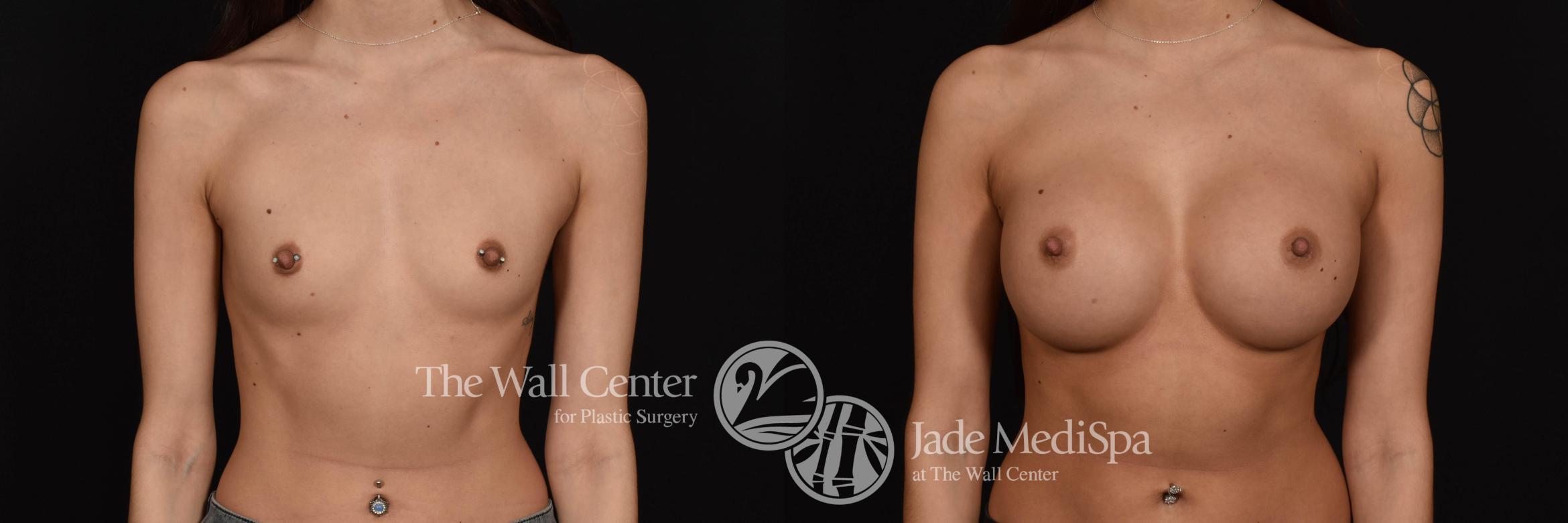 Breast Augmentation Front Photo, Shreveport, Louisiana, The Wall Center for Plastic Surgery, Case 742