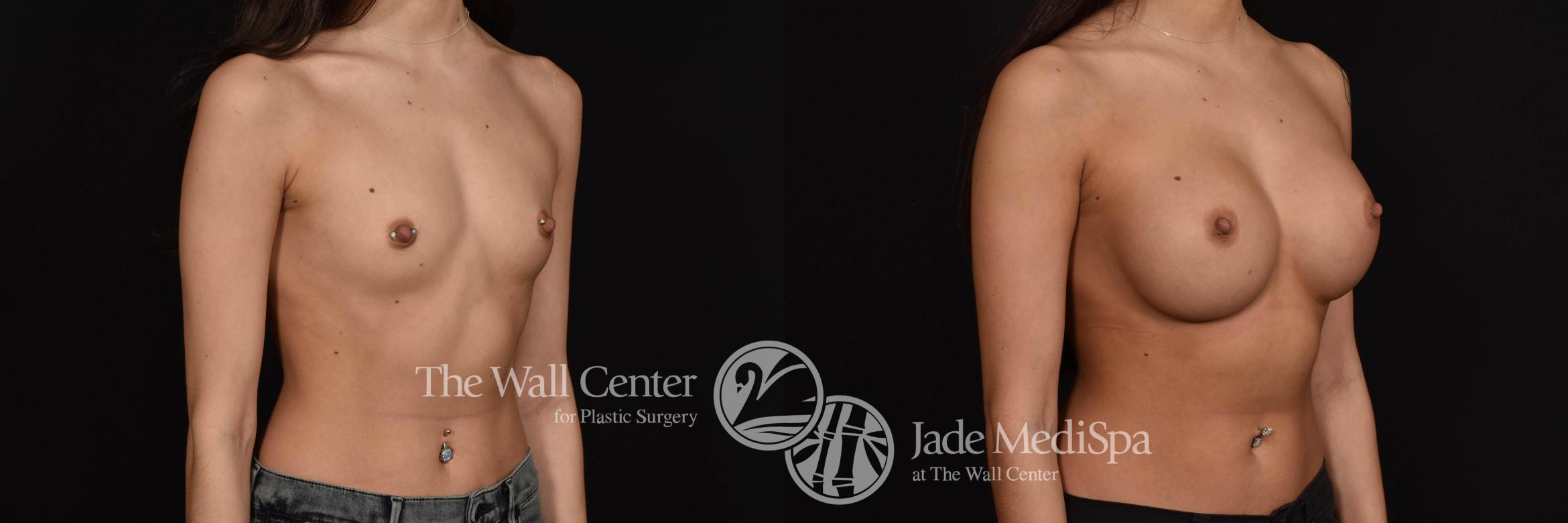 Breast Augmentation Front Photo, Shreveport, Louisiana, The Wall Center for Plastic Surgery, Case 742