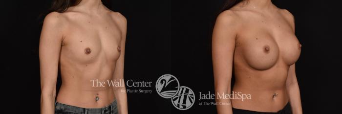 Breast Augmentation Front Photo, Shreveport, Louisiana, The Wall Center for Plastic Surgery, Case 742