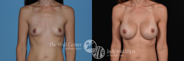 Before & After Breast Augmentation Case 764 VIEW #1 View in Shreveport, LA
