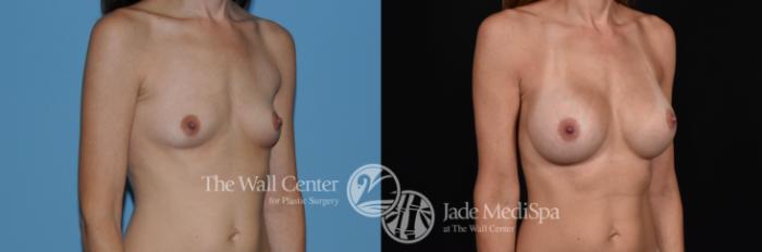 Before & After Breast Augmentation Case 764 VIEW #2 View in Shreveport, LA